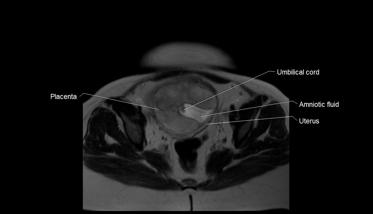 MRI fetal anatomy axial image 34.webp